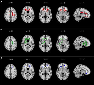 Gait decline while dual-tasking is an early sign of white matter deterioration in middle-aged and older adults